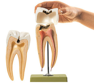 Molar Tooth with Caries (ES 8)