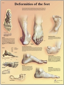 Deformities of the Feet Chart(VR1185)