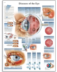 Diseases of the Eye Chart(VR1231)