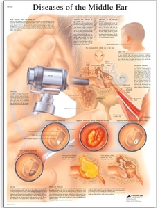 Diseases of the Middle Ear Chart(VR1252)