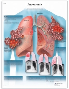 Pneumonia Chart(VR1326)
