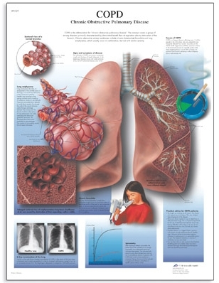 COPD Chart - Chronic Obstructive Pulmonary Disease(VR1329)